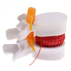 Demonstrate of Disc of Bone